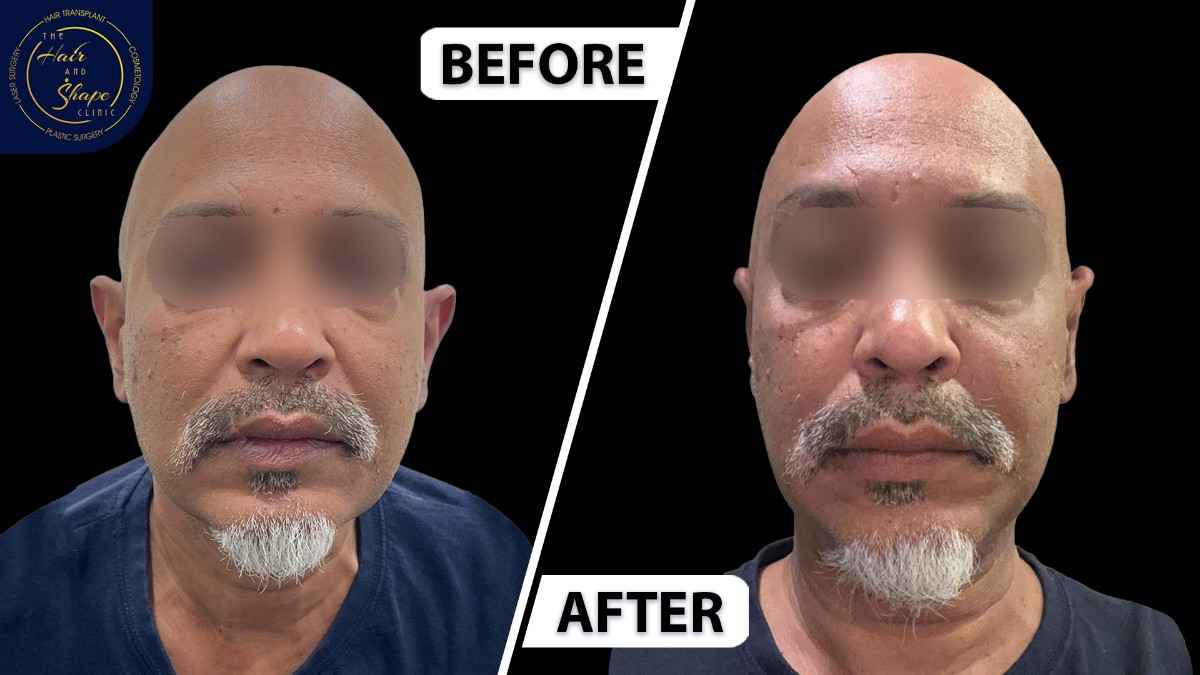 Face & Neck Lift result11